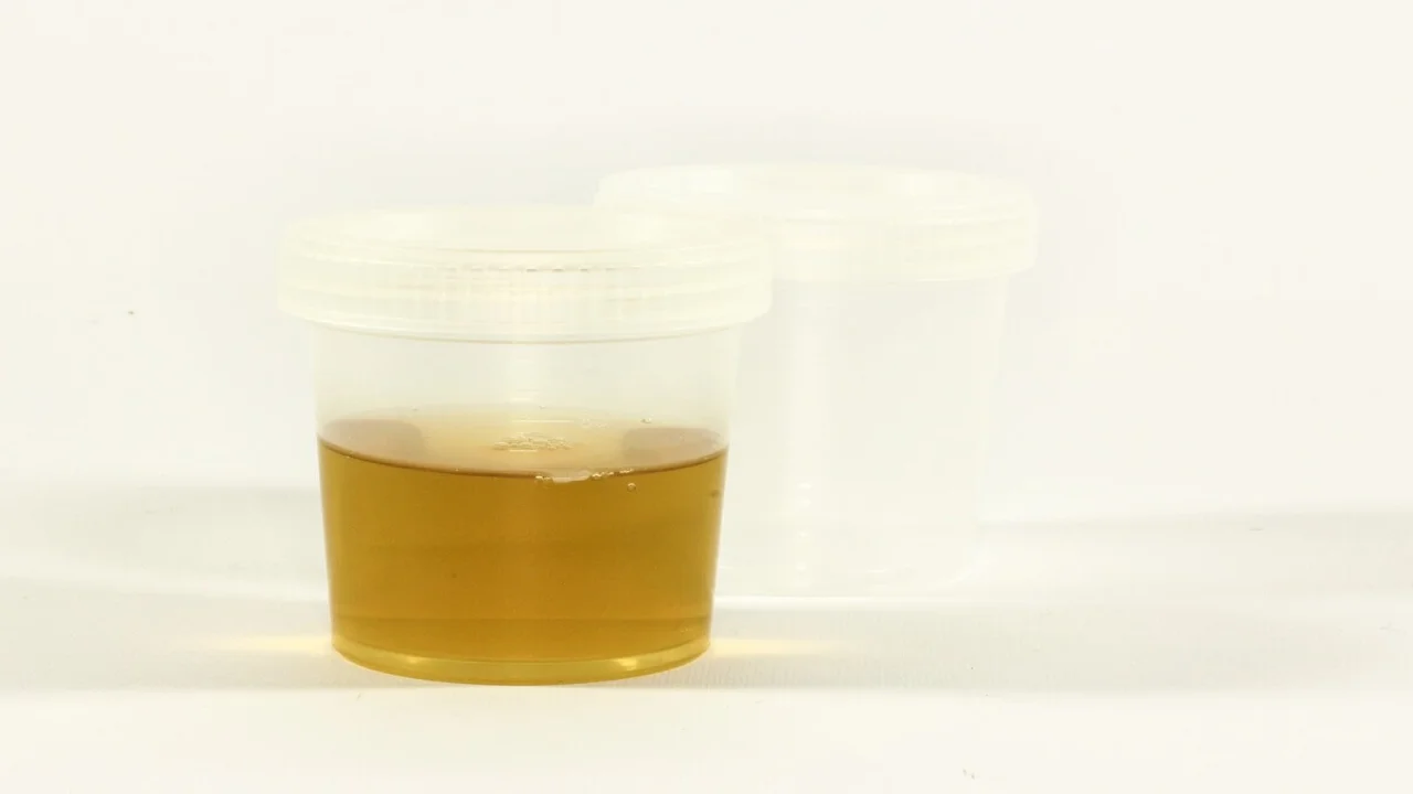 Urine Specimen for Proteinuria