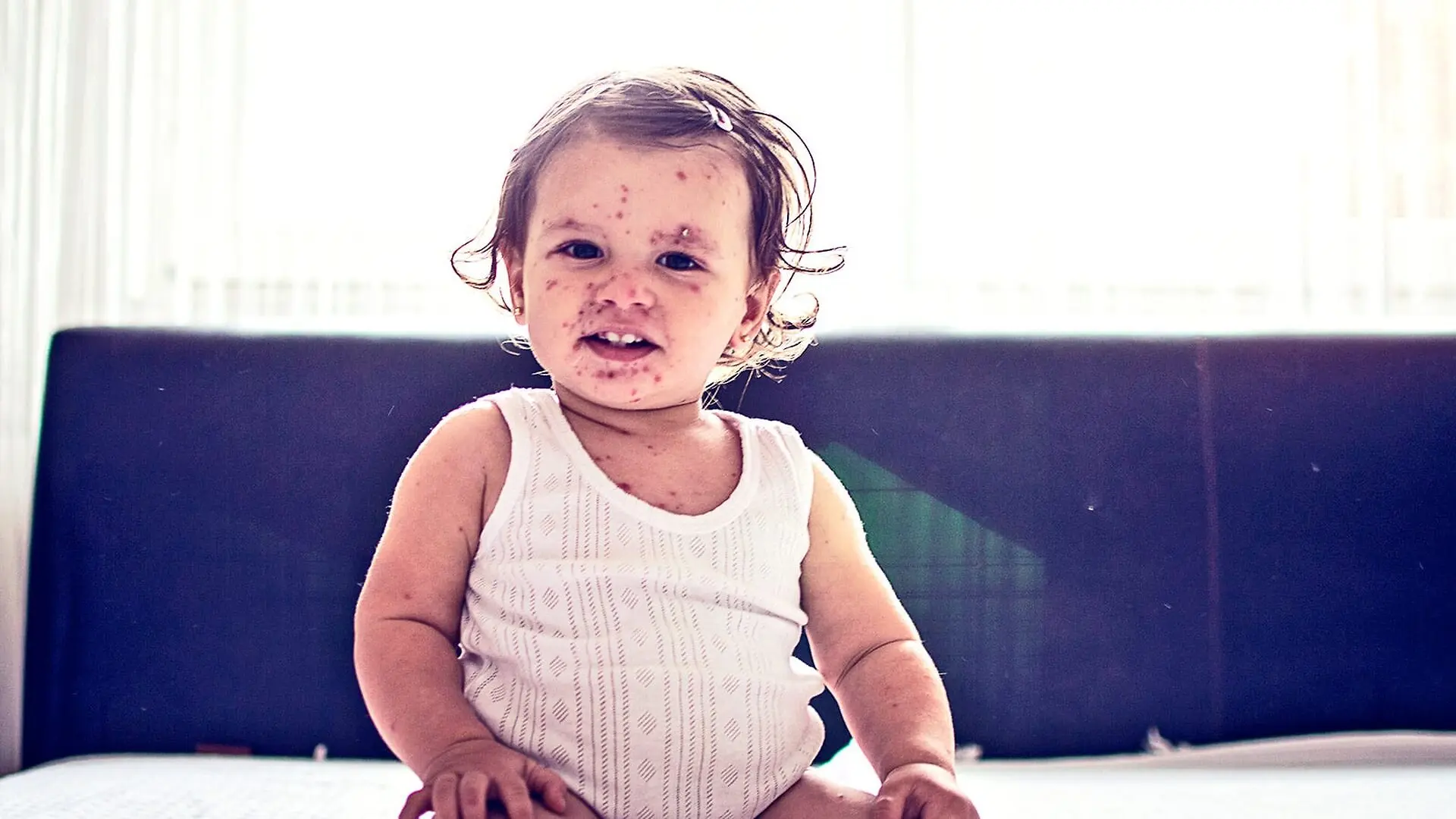 A baby with measles sits on a bed looking at the camera.
