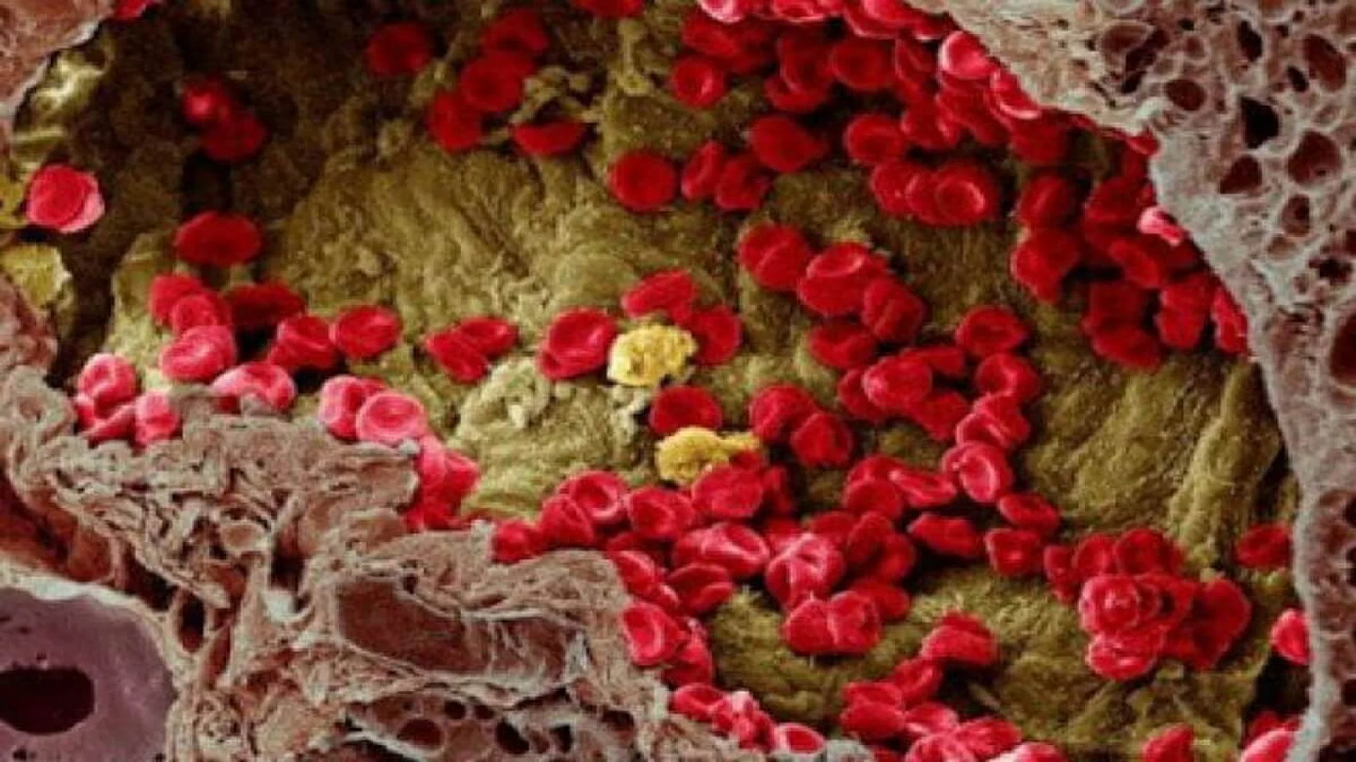 Scientists have finally figured out how cancer spreads through the bloodstream