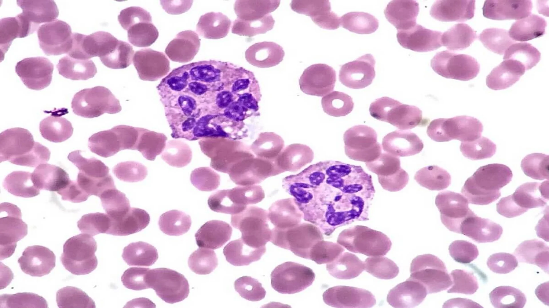 Hypersegmented Neutrophils