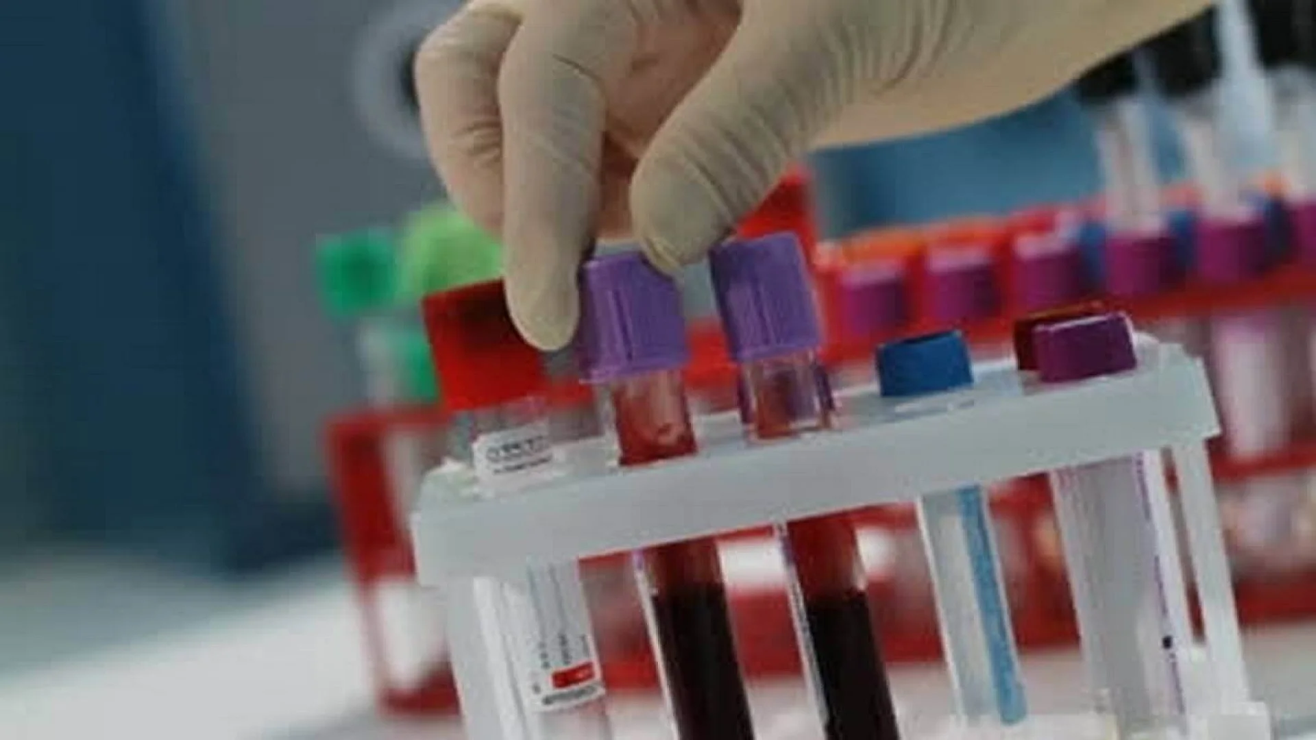 Contamination of Laboratory Equipment with Bloodborne Pathogens.