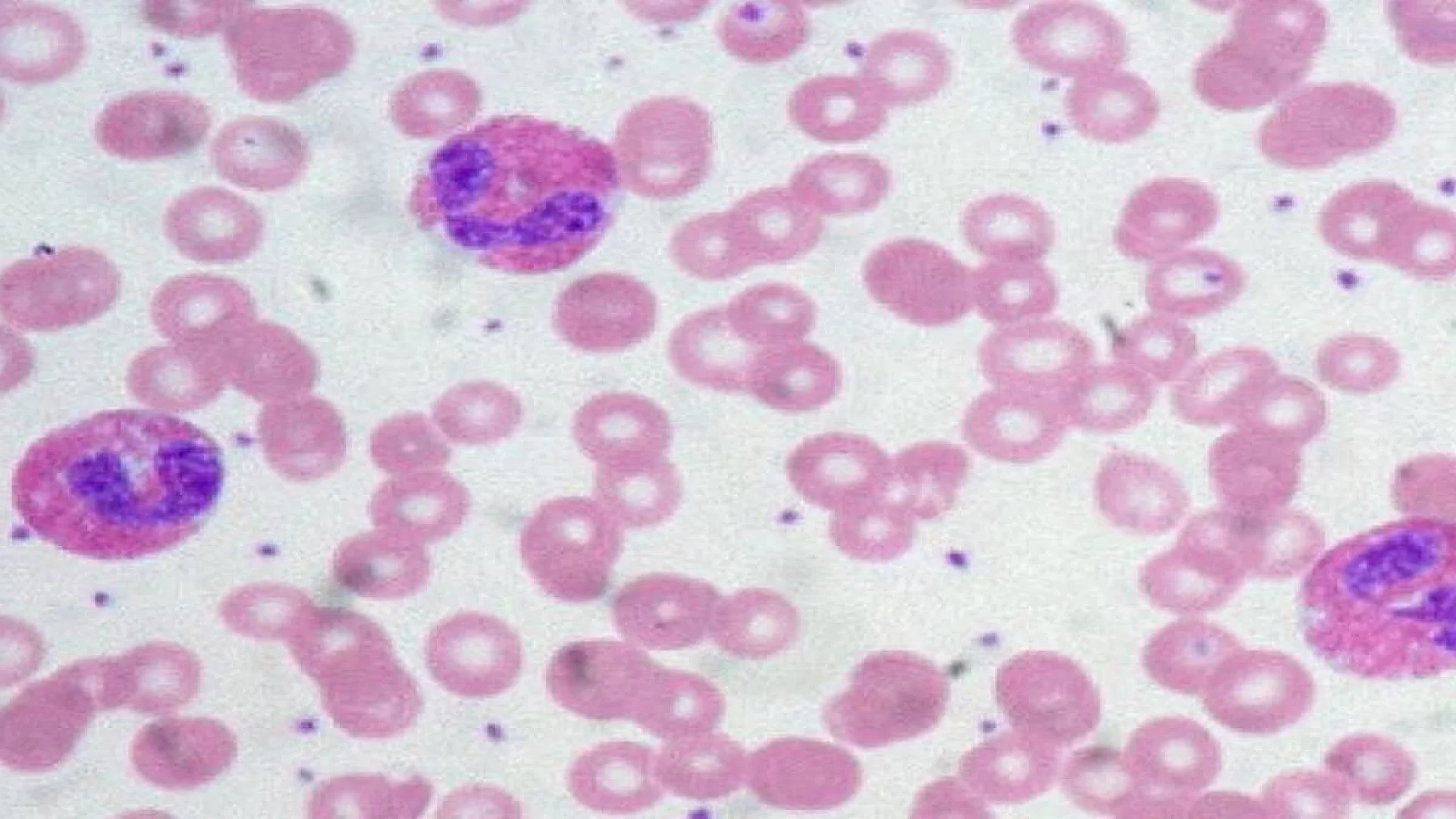 Blood Eosinophil Level Predicts Severity of Asthma.