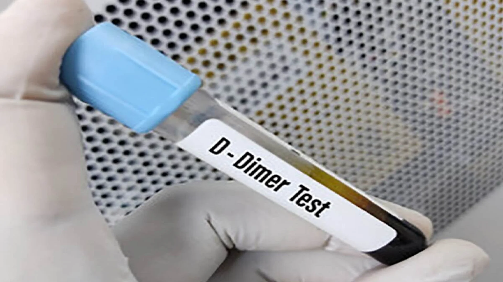 D Dimer Blood Test Sample