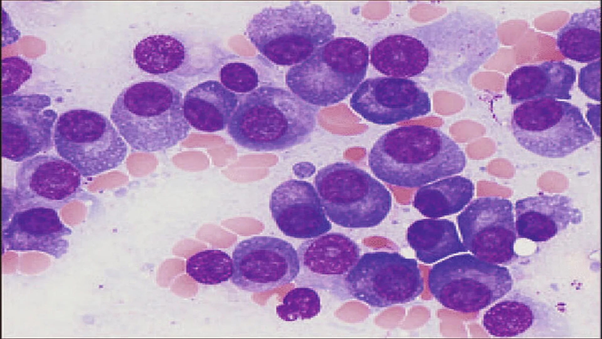 Bone marrow in multiple myeloma showing plasmacytosis.