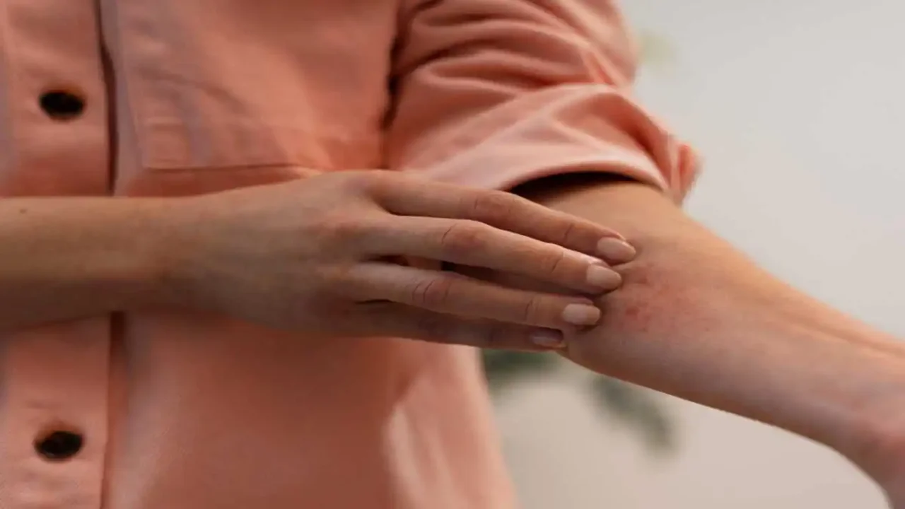 A round rash on a man’s hand that is one of the common symptoms of lyme disease