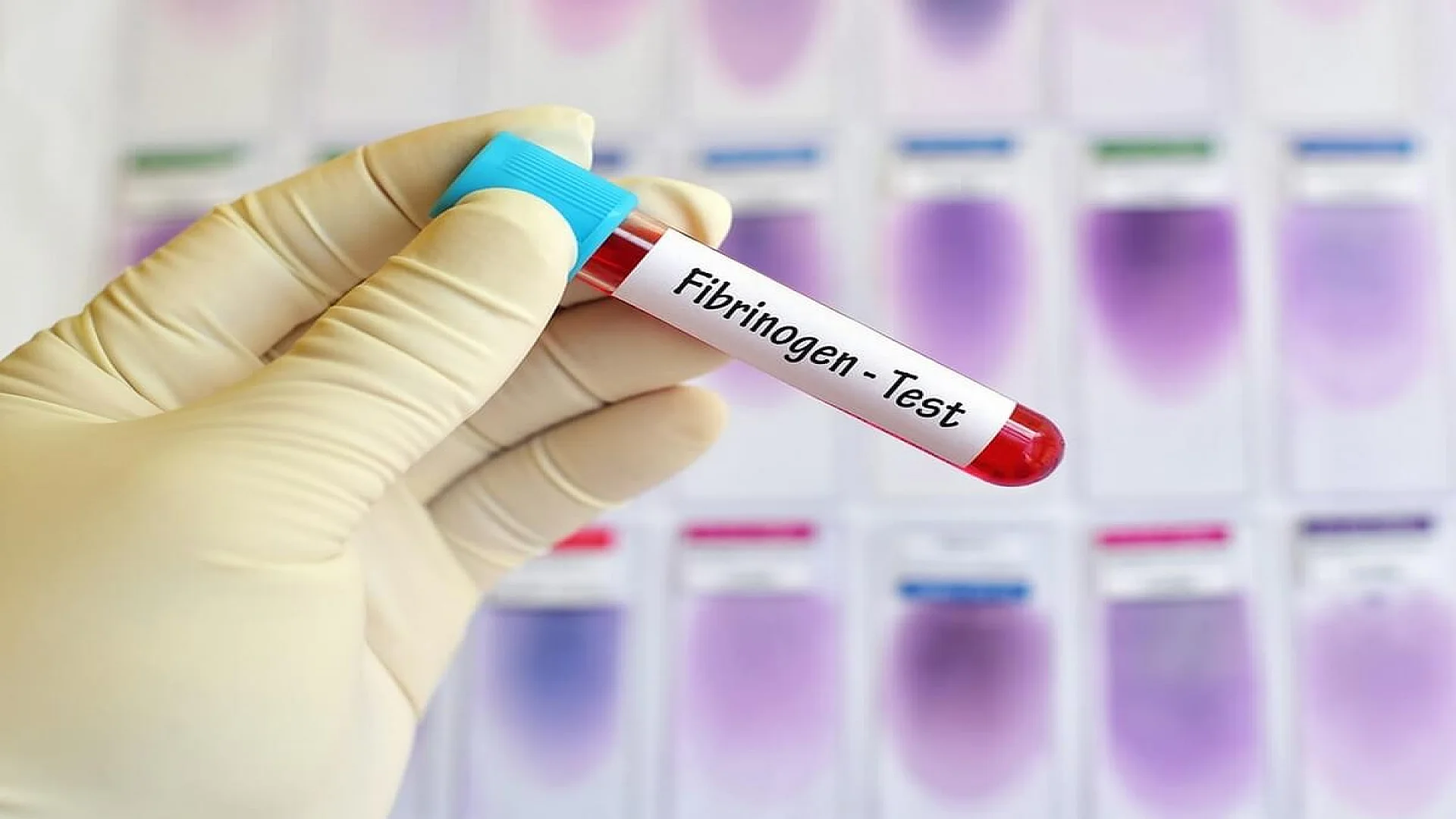 Test tube with blood sample for fibrinogen test, coagulation disorder diagnosis.