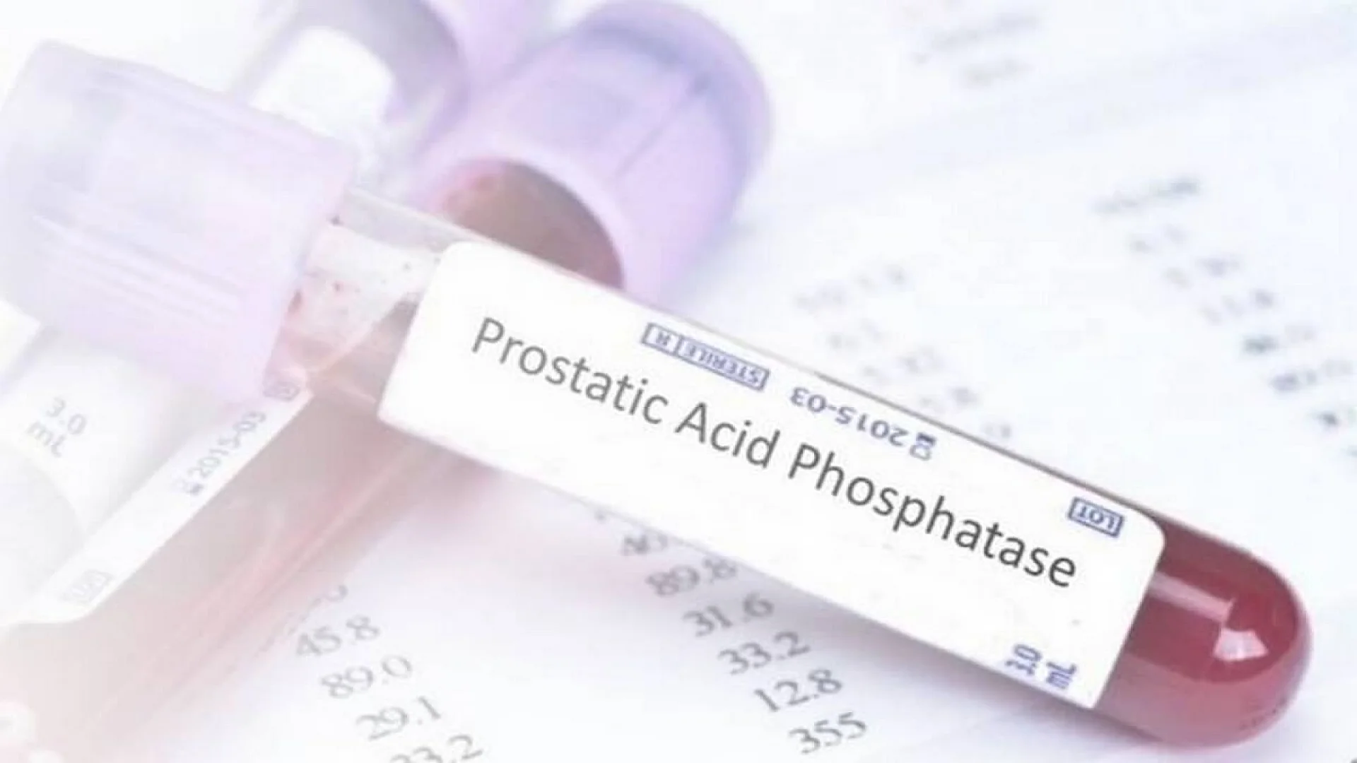 Acid Phosphatase (AP): Total and Prostatic Acid Phosphatase.