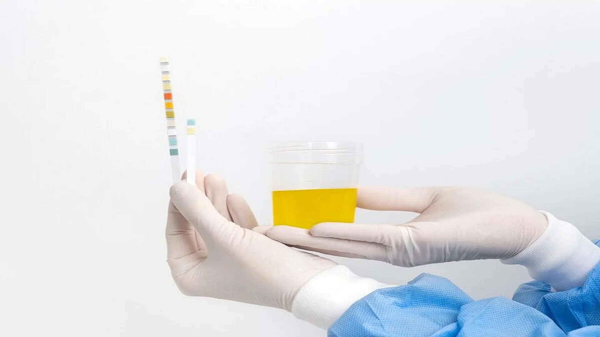 Urine Specimen for Han’s Test