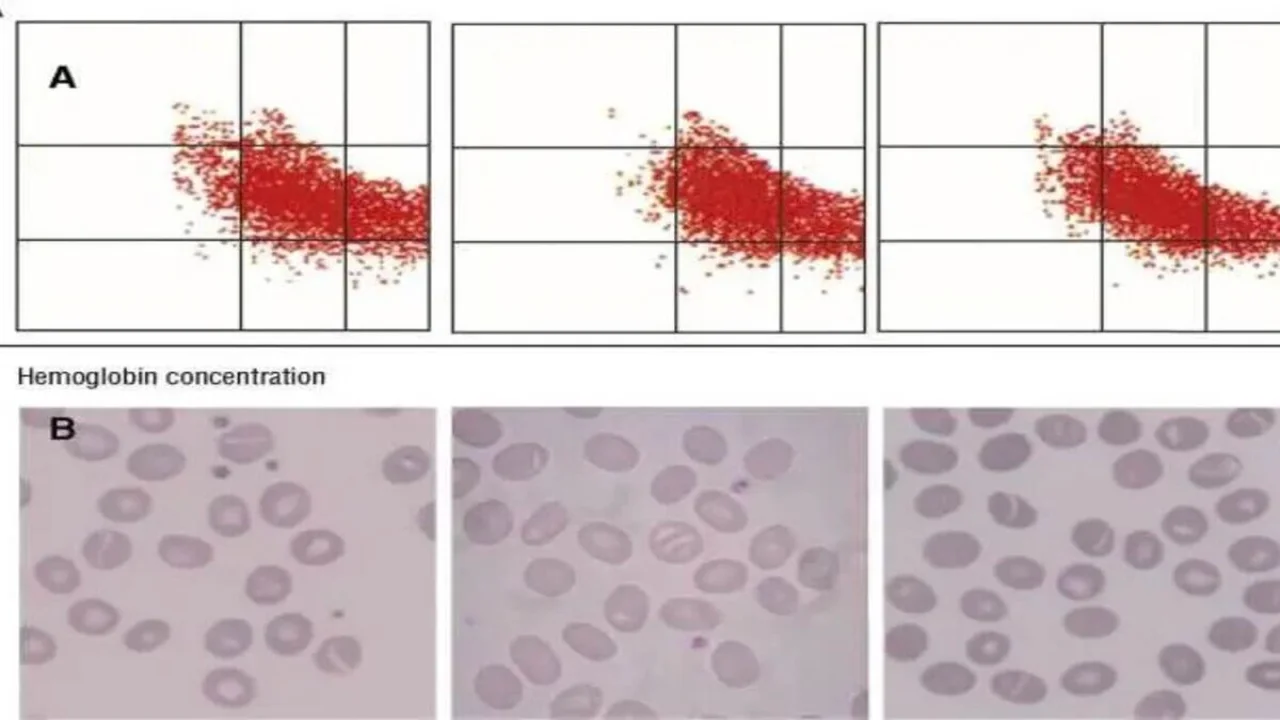 Southeast Asian ovalocytosis.