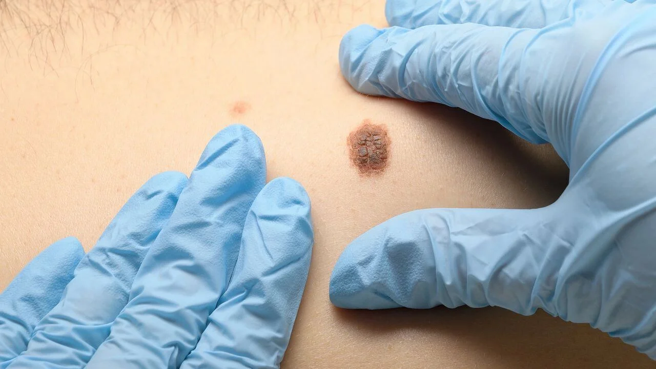 Basal Cell Carcinoma