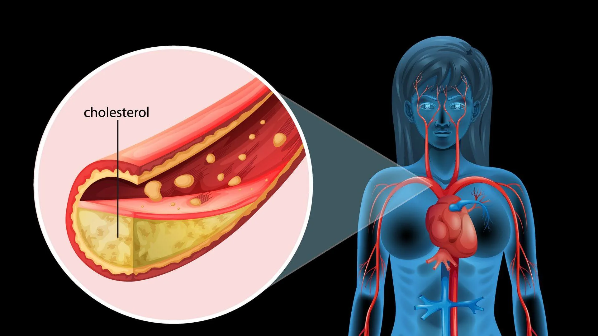 A medical diagram showing a cross-section of a blood vessel with yellow cholesterol deposits narrowing the passage, positioned next to a blue silhouette of a female figure showing the heart and circulatory system.
