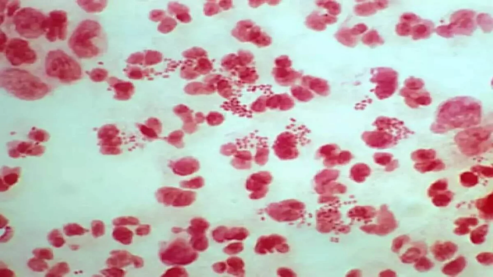 The infection is caused by the bacteria Neisseria gonorrhoeae.