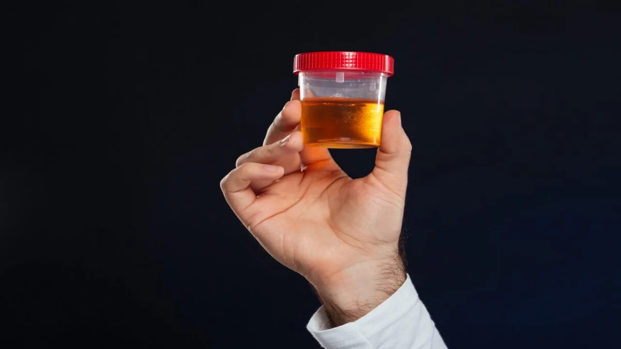 Urine Protein Electrophoresis