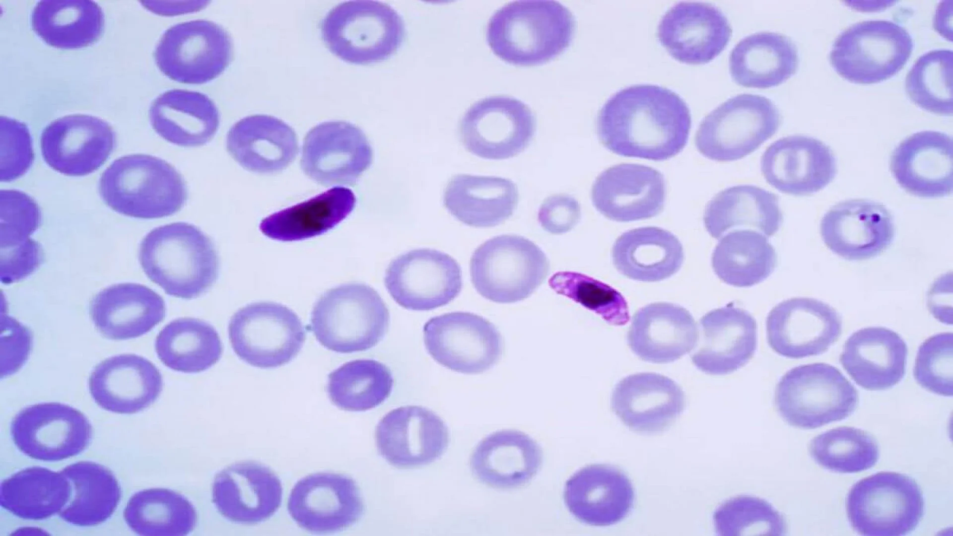 Blood smear of Plasmodium falciparum (gametocytes - sexual forms).