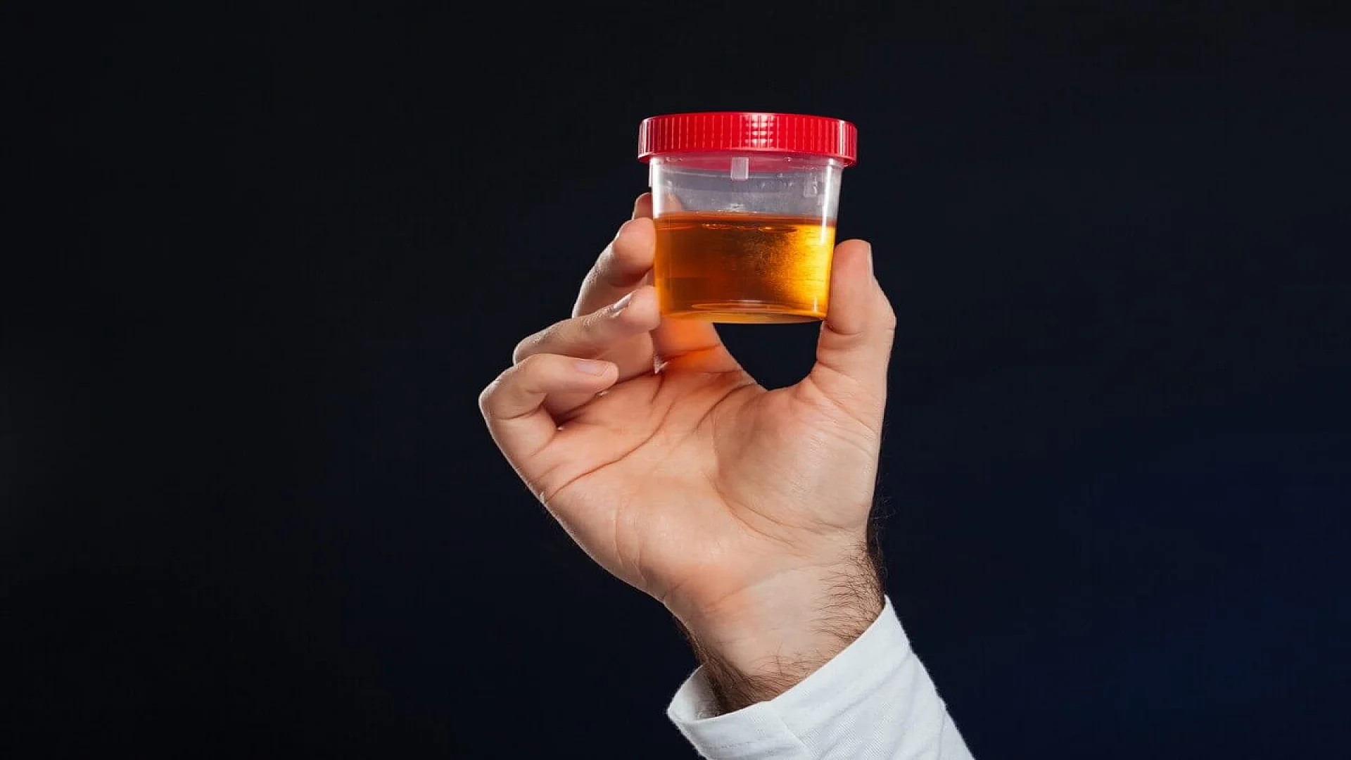 Urine Protein Electrophoresis