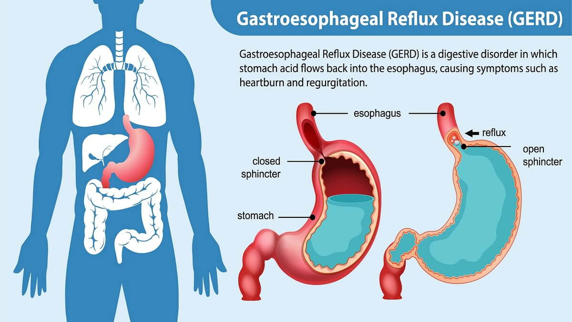 Gastroesophageal Reflux Disease GERD Diagram.