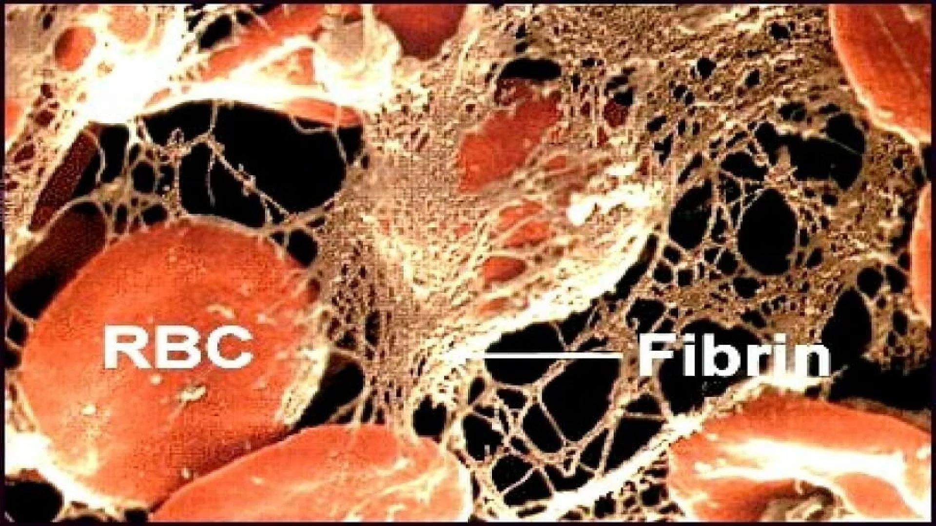 Red blood cells trapped by Fibrin.