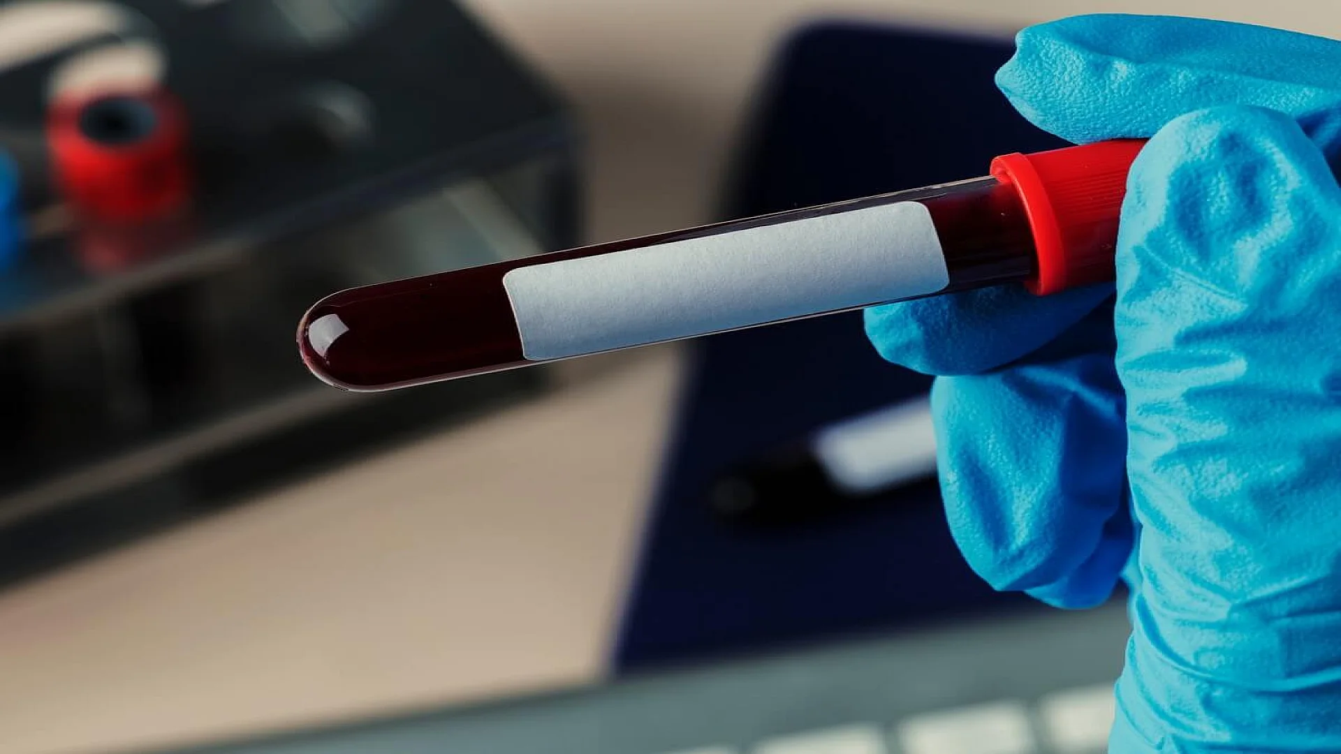 Surgeon holding a blood test tube.
