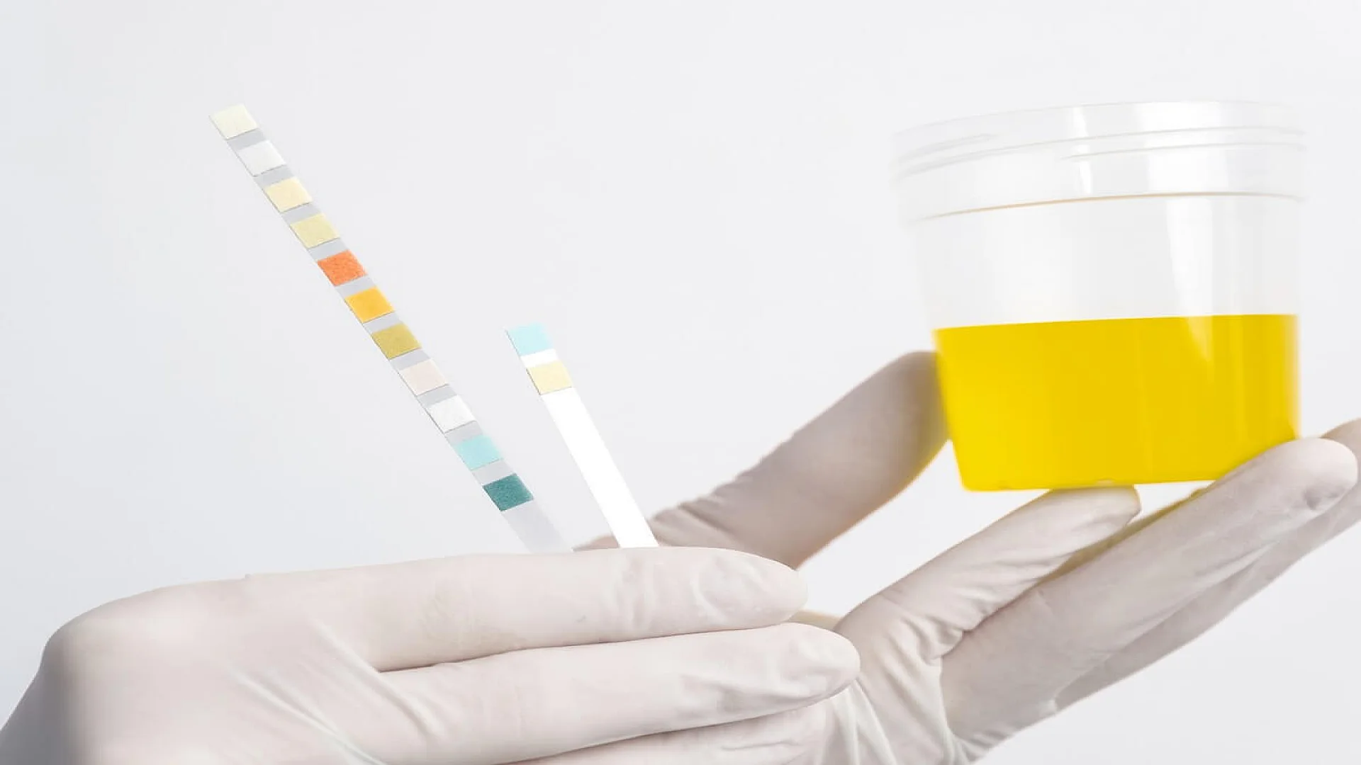 Urine Specimen for Lang’s Test