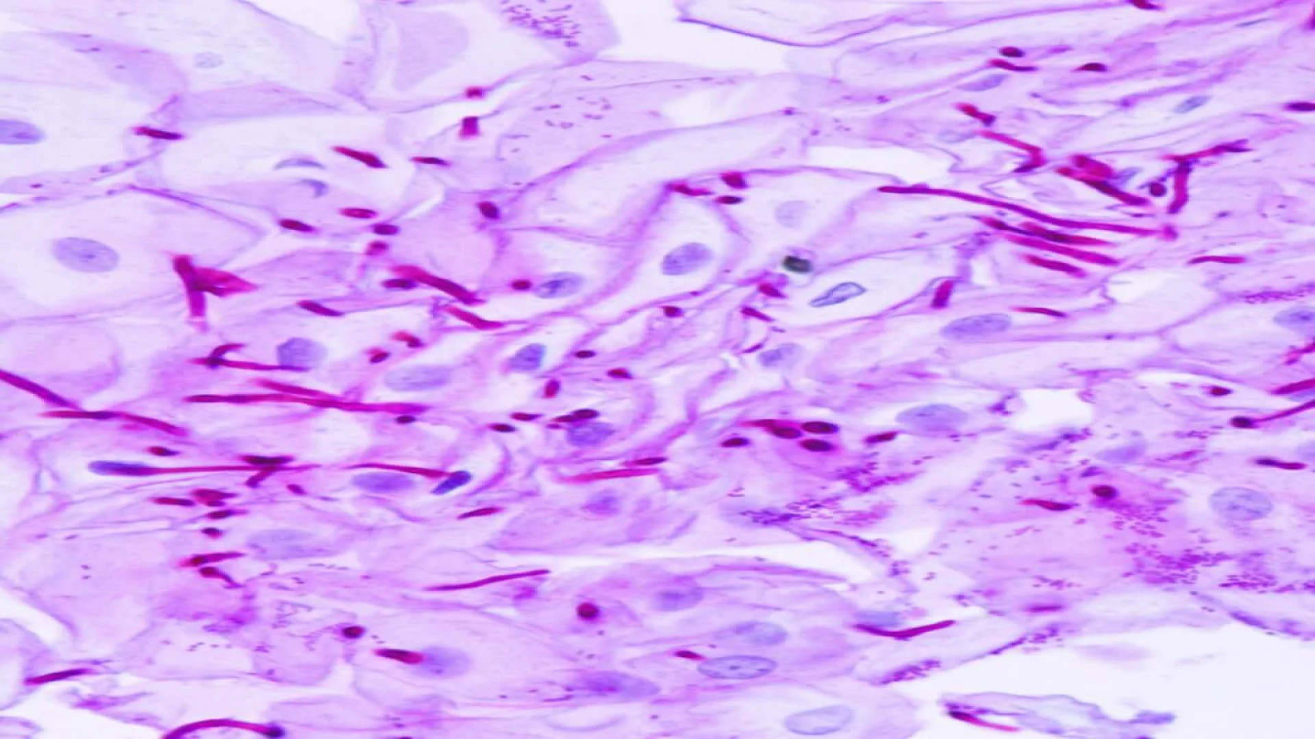 Esophageal candidiasis Stained with Periodic Acid Schiff Stain