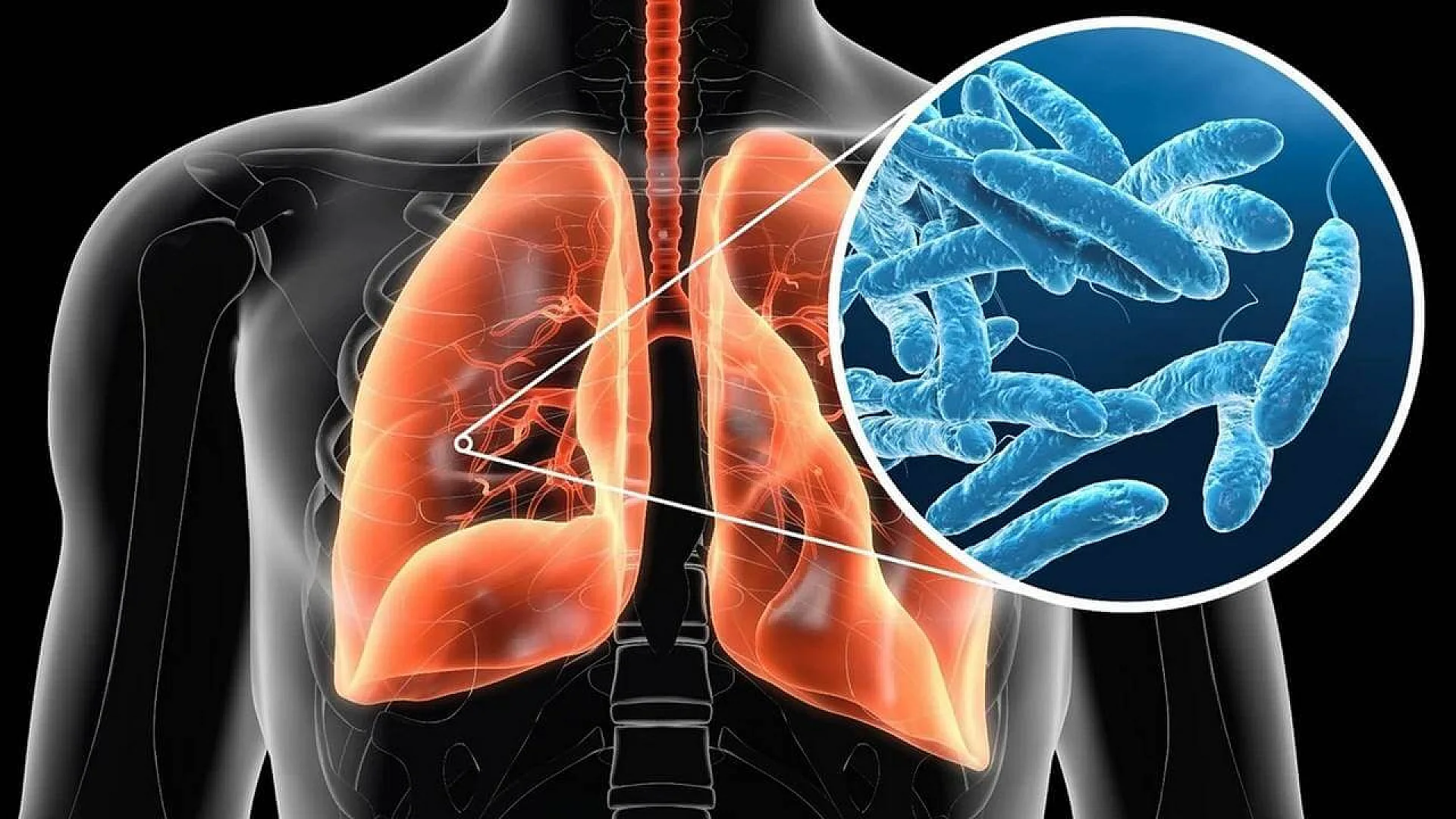 Legionnaires Disease