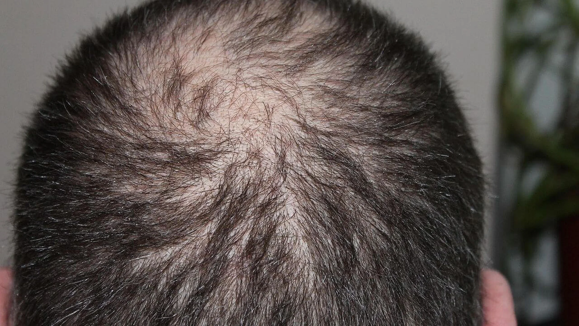 Close-up overhead view of a person’s scalp showing significant thinning hair and male pattern baldness at the crown.
