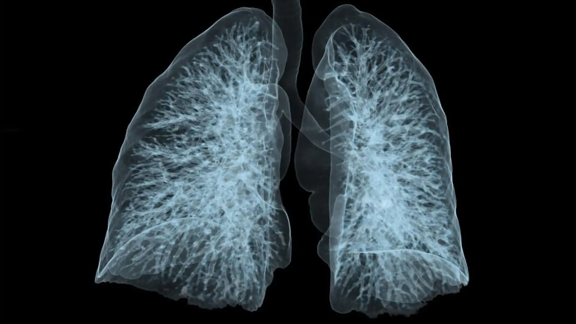 3d Ct Scan Of Human Lungs Highlighting The Pulmonary Vessels Scaled