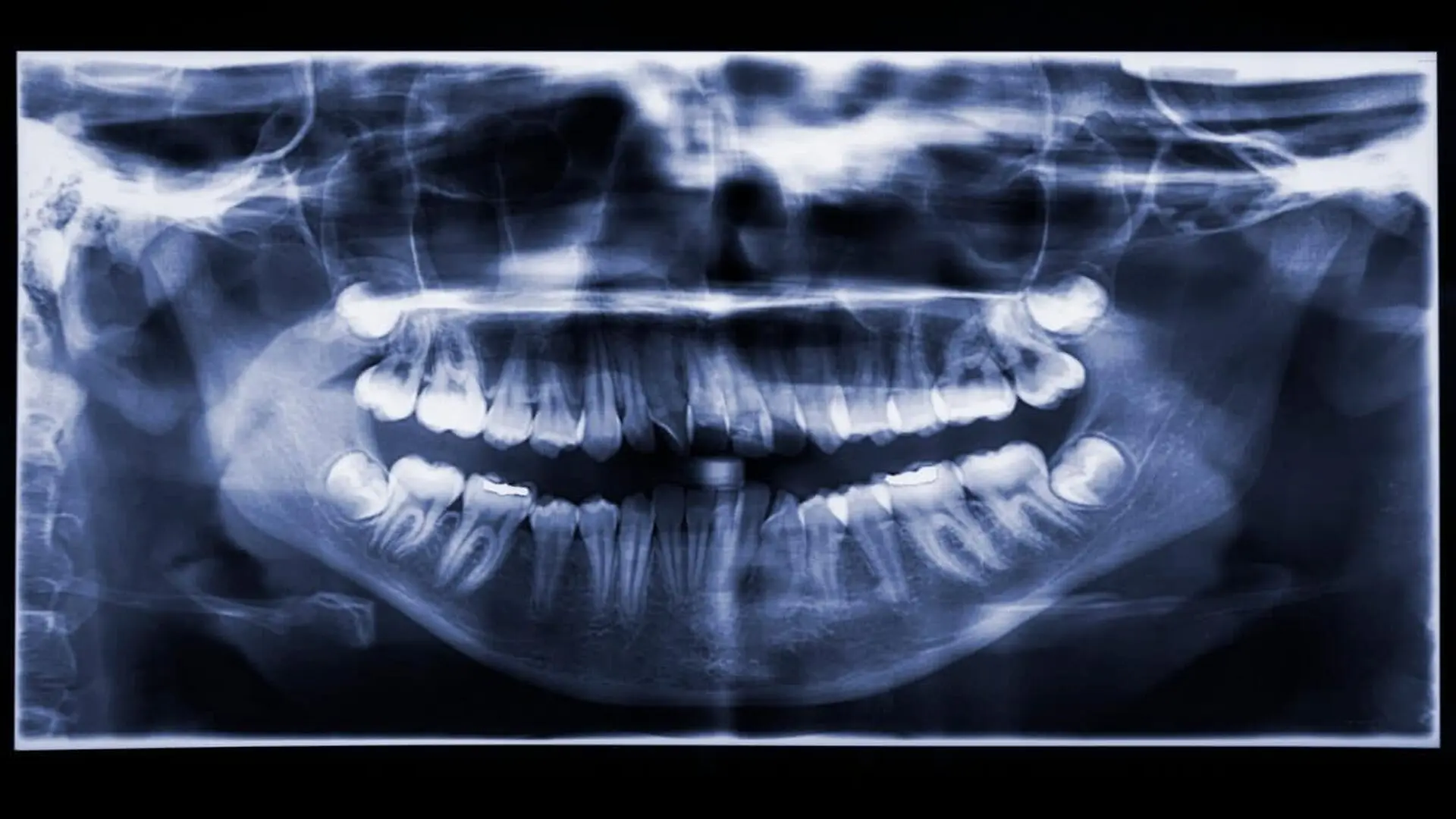 Close Up Of The Patients Dental X Ray Imag Scaled