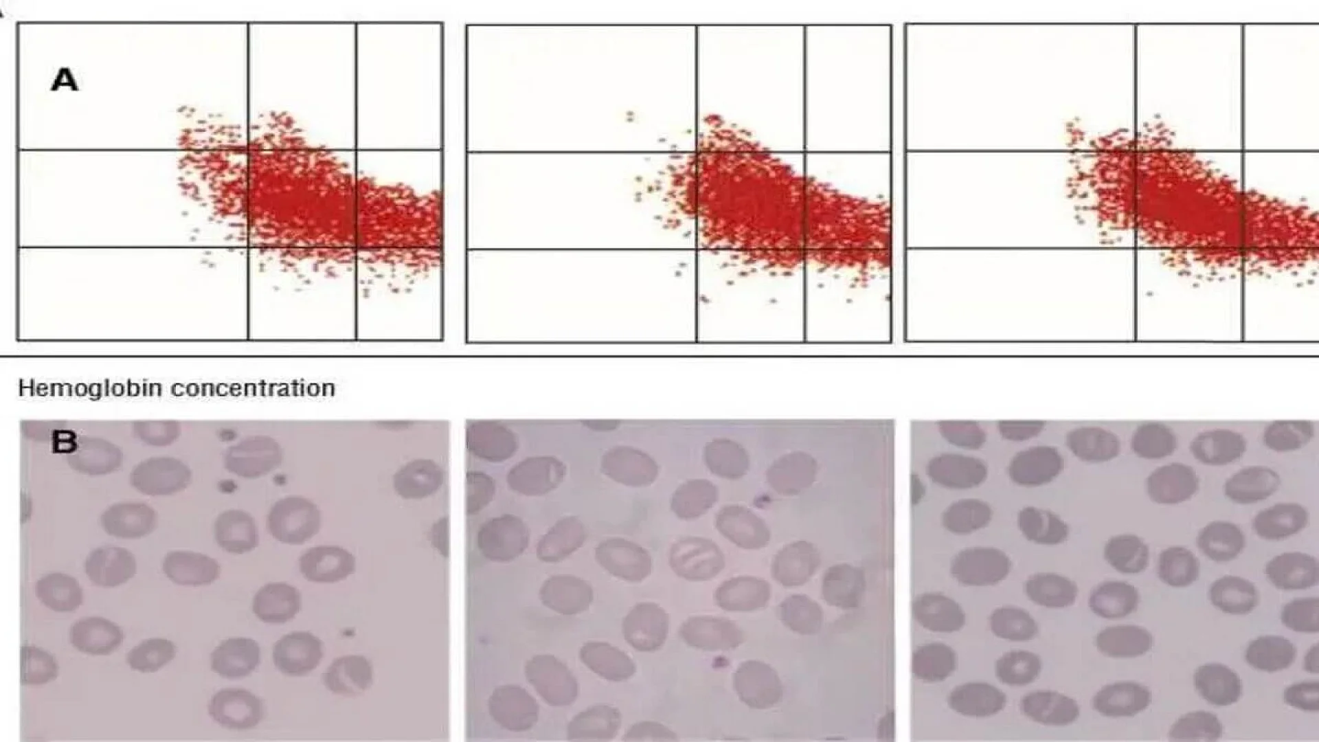 Southeast Asian ovalocytosis.