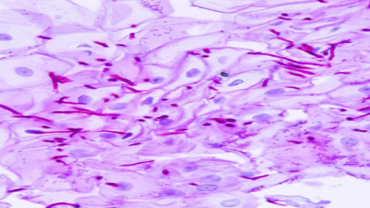 Esophageal candidiasis Stained with Periodic Acid Schiff Stain