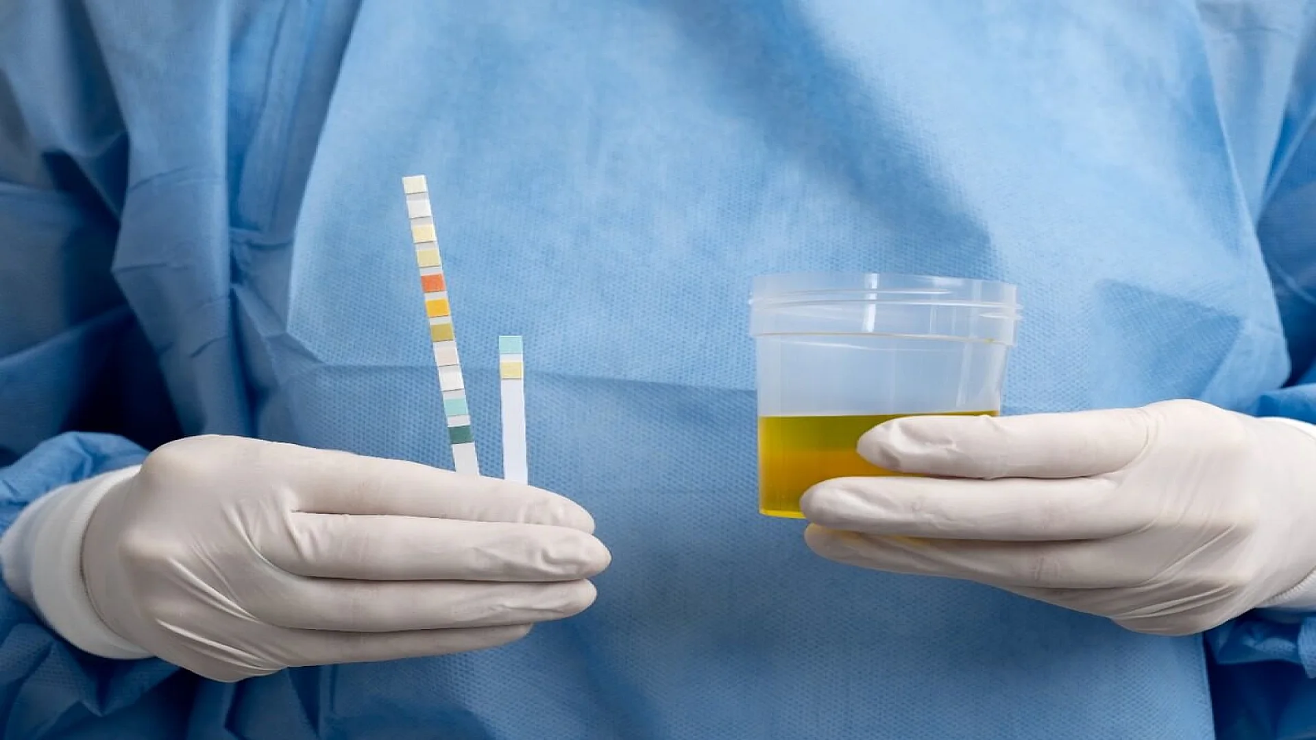 Urine Specimen for Lindeman’s Test