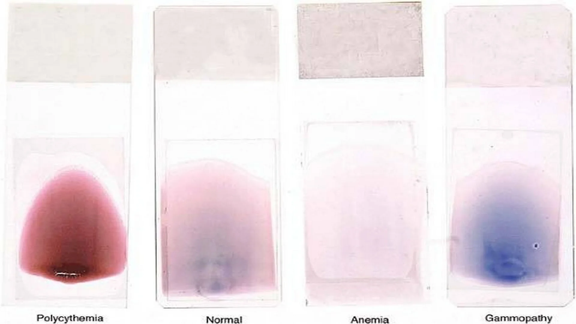 Peripheral Blood Smear: The color of blood smears can reflect severe underlying abnormalities in hematocrit and the presence of abnormal circulating immunoglobins.