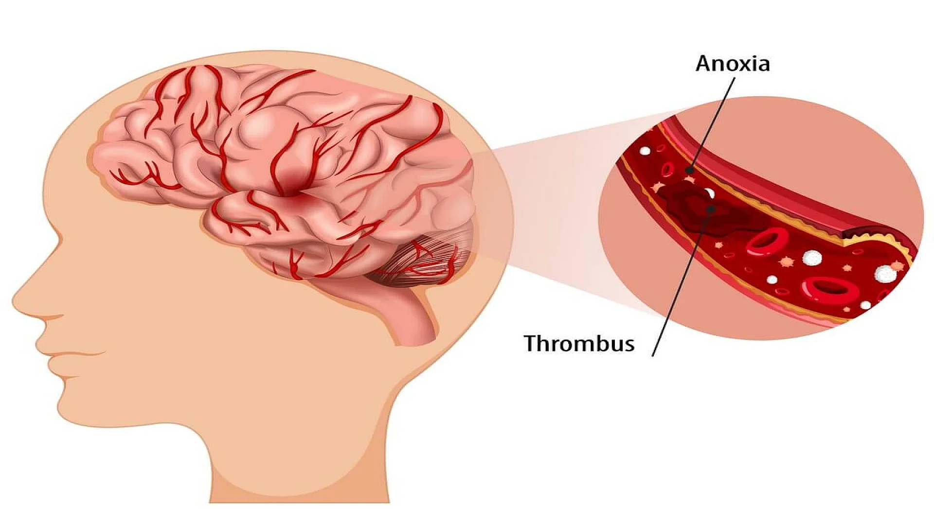 Free vector human with ischemic stroke.