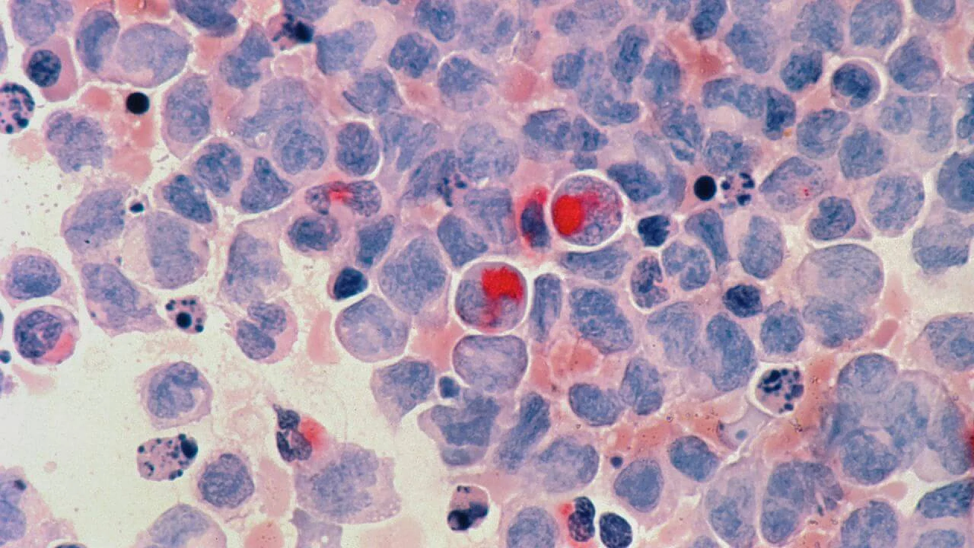 Acute myelocytic leukaemia