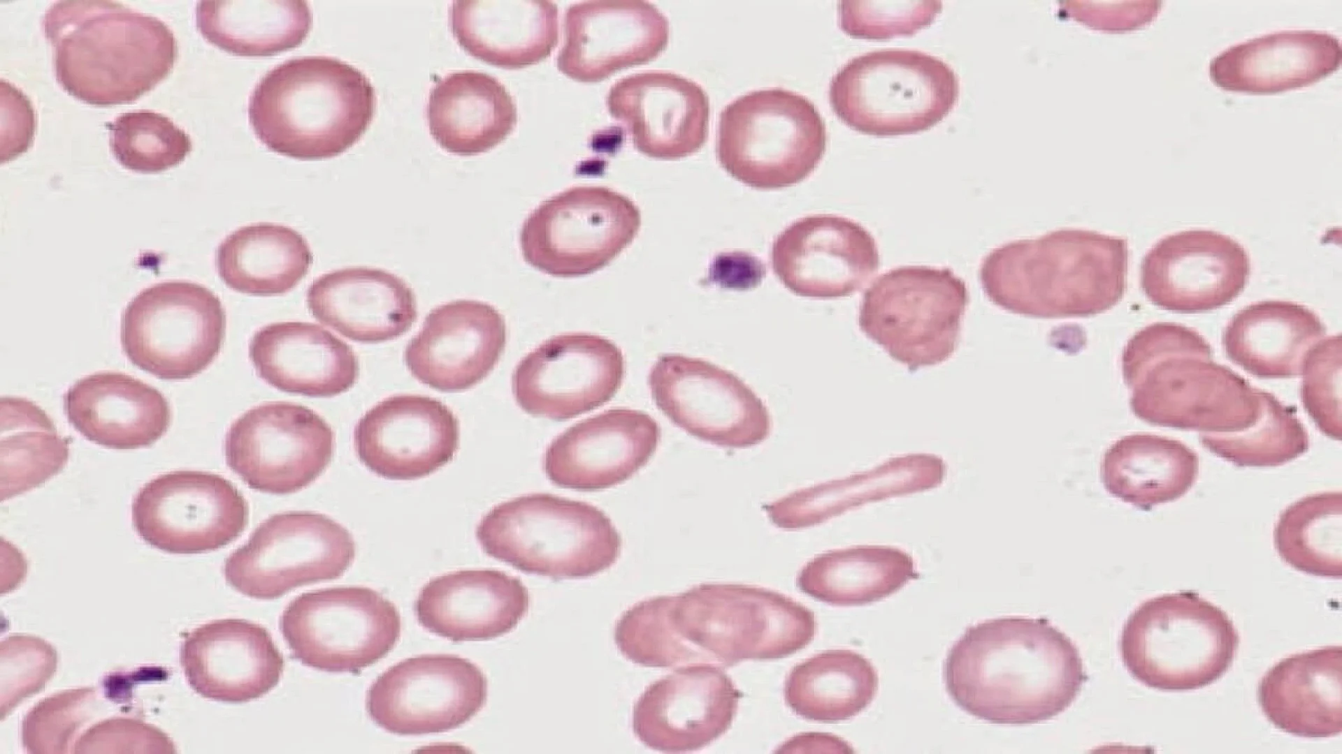 Iron-Deficiency Anemia in Ulcerative Colitis.