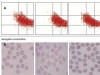 Incidental finding of 3 Southeast Asian ovalocytosis cases by attentive examination of blood smears