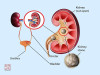 Renal Biopsy: Indications, Contraindications, Complications and Procedure