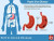 Free vector peptic ulcer disease infographic.