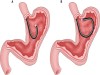 Contraindications to Gastric Analysis