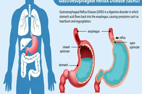 Gastroesophageal Reflux Disease GERD Diagram.