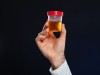 Urine Albumin and Albumin/Creatinine Ratio