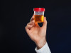Urine Albumin and Albumin/Creatinine Ratio