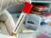 Examination of Cerebrospinal Fluid (CSF)
