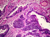 Wyeth and Novartis Show Interest in Endogen: A Medical Breakthrough Shown to Reverse The Cause of Endometriosis