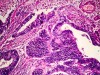 Wyeth and Novartis Show Interest in Endogen: A Medical Breakthrough Shown to Reverse The Cause of Endometriosis