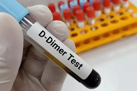 D Dimer Blood Test Sample