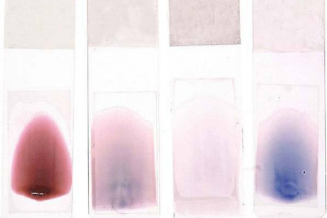 Peripheral Blood Smear: The color of blood smears can reflect severe underlying abnormalities in hematocrit and the presence of abnormal circulating immunoglobins.