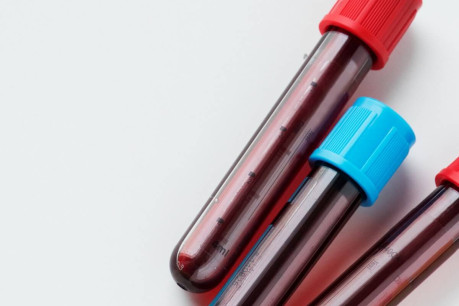 Steps for Blood Sample Preservation for PT/APTT