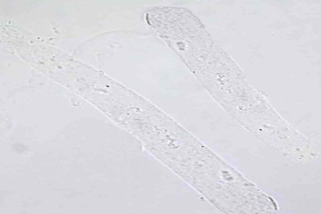 Hyaline Casts