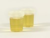 Gerhardt’s Test: Detecting Ketone Bodies in Urine with Ferric Chloride